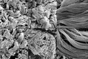 Picture of scar tissue before and after MSTR